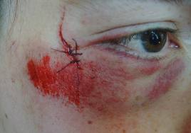 Facial injury - blunt force trauma