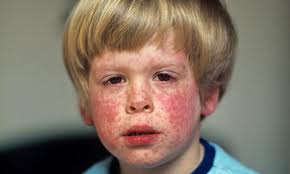 A severe case of measles.