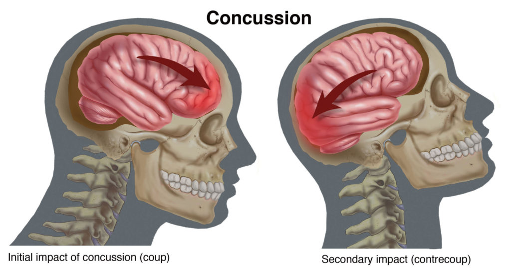 Concussion- skull image