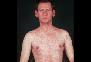 Measles - male